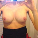 1 week post revision Capsullhaphory