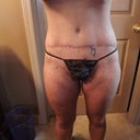 6 months after still horribly disfigured. I don't know how to deal with it