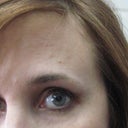 4 weeks forehead welts