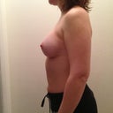 L side @ 6wks