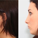 side profile-before & after rhinoplasty