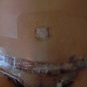 PO Day 3 - Time to remove the dressing!  OMG this was painful but alcohol wipes helped tremendously!!!!
