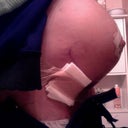 AFTER: Breast Day 5 (cellphone photo) SIDE