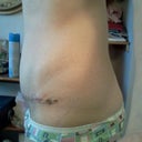 Day 15-side Looking more normal! YEAH!