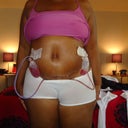 Day 2 with my drainage tubes standing. Very swollen. New belly button is a little strange, but I see the promise :)