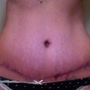 scar 21 weeks