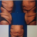 5-11-11 Pre-op