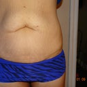 Front View before surgery today.