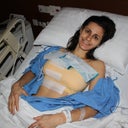 my post op with m compression bandage, this should come off today and i will get to see them.