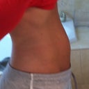 Side - 5 days after procedure - mostly representative of "before"