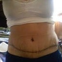 3weeks post-op