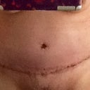 14 days post op
