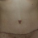 Scar at 6 months post op