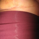 Left underside 2 wks