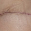 05/03/13-PO 4 WEEKS left side