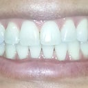 3 months post after cosmetic bonding to lengthen 4 uppers