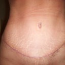 tummy tuck scar 2 months ( very happy with it thus far) just got done working out so have a bit of swelling in this pic