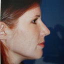 8 wks post-op