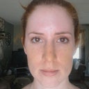 after the tape came off! 2 weeks post-op. Look how swollen it was. Sad monkey:(