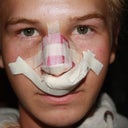 Day 1 after surgery