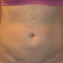 2wks out front-still swollen & a lil hard/lumpy now...