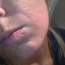 Pre fraxel, shallow scars and uneven skin tone