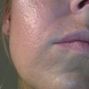 Pre fraxel right cheek