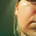1 day after 1st treatment, right cheek.