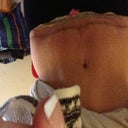 Scar 7 weeks