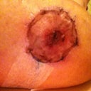 Right nipple, 13 days post-op.