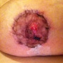 Left nipple, 13 days post-op.