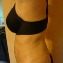 11 days after procedure