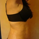 11 days after procedure