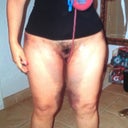 1 day post op!!