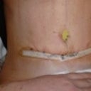 Day of operation Nov. 7, 2012. Me on the flat side!