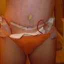 Day of operation Nov. 7, 2012. Showing off my lovely drain tubes, but on the flat side!