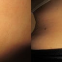 back lipo scar (above butt). left: approximately 3 weeks, right: 7 weeks.