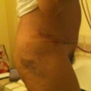 Post Op Day 4 Right Side