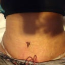 Post op day 4