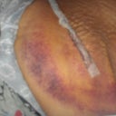 Lipo swelling post op day 4