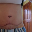 8 days post op