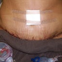 1 day op
