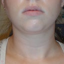 6 Weeks Post - Front