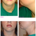 Side by side before compared to week 5