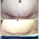 Top scar was 1 month ago - bottom from today....I think it's looking good!