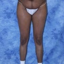 before surgery front view