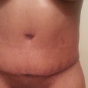 Just seen I have not posted an incision pic.