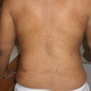 After - 3 Days post op