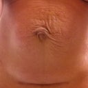 before surgery