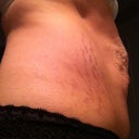 day of surgery